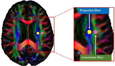 Glymphatic system impairment in nonathlete older male adults who played <mark class="highlighted">contact sports</mark> in their youth associated with cognitive decline: A diffusion tensor image analysis along the perivascular space study